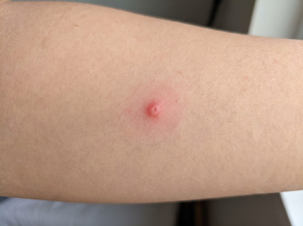 Close-up of a red linear skin streak with small blisters characteristic of rove beetle contact dermatitis